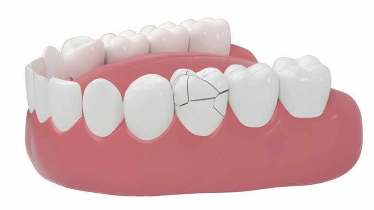 Está com o dente quebrado? Veja aqui o que fazer!