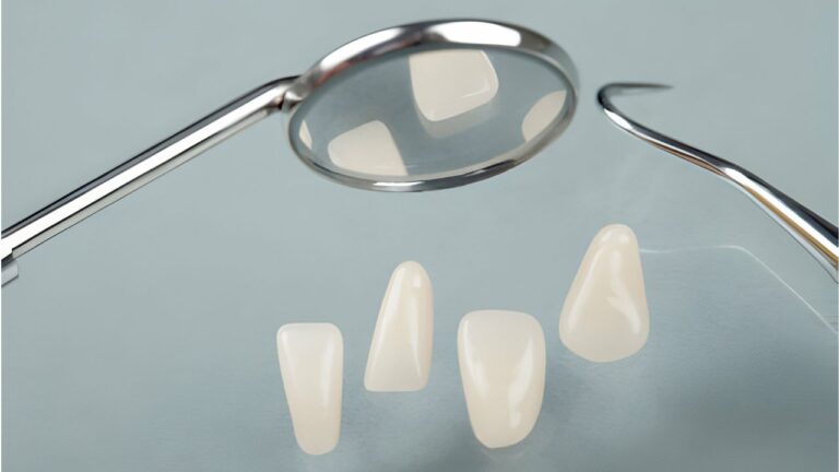 Lentes de resina: o melhor procedimento estético bucal!