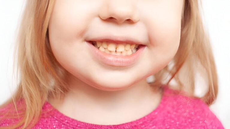 Fluorose infantil: problema bucal que preocupa! Saiba mais!