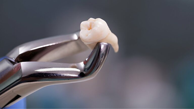 Quanto custa uma extração de dente? Saiba aqui os valores!