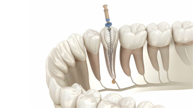 Quer saber quanto custa um canal dentário? Veja os valores!