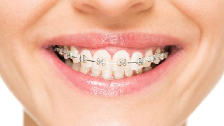 Aparelho de dente: descubra tudo sobre aparelhos dentários!
