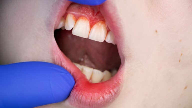 Mucocele na boca: tudo que você precisa saber está aqui!
