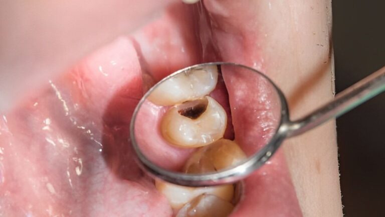 Como tratar cárie no dente e como prevenir? Saiba de tudo aqui!