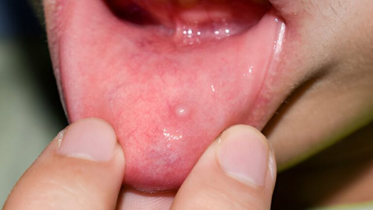 Sintomas de mucocele: o que você precisa saber!