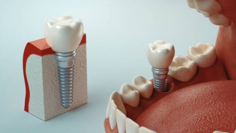 Próteses Dentárias: guia completo sobre o tratamento!